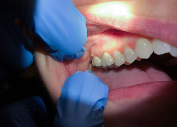 Best Emergency Wisdom Teeth Removal in Bay City, TX
