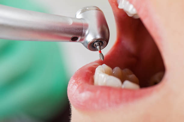 Best Emergency Tooth Extraction in Bay City, TX
